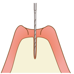 implant001_コピー