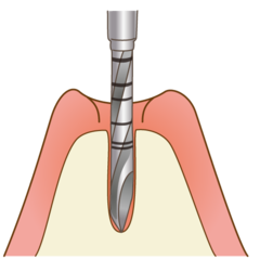 implant002_コピー