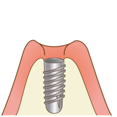implant003_コピー