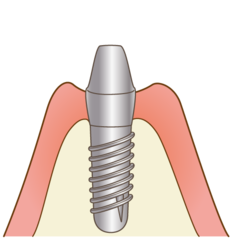 implant005_コピー