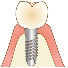 implant006_コピー