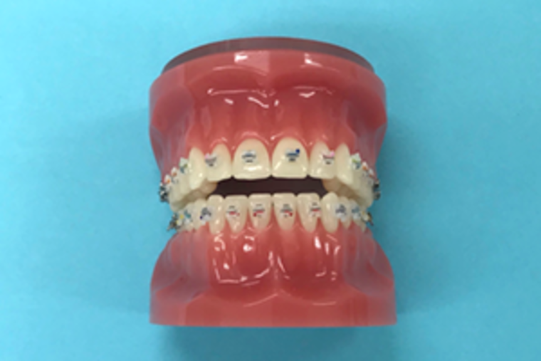 成人矯正 ブラケット _コピー